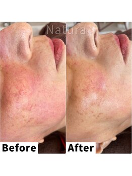 ナトゥーラ 心斎橋なんば本店(Natura)/赤み.敏感肌ケア/心斎橋なんば