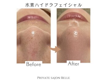 ベル(Belle)/水素ハイドラのビフォアフ☆