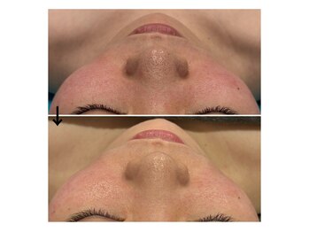 サロン テン(salon TEN)/月1、2回のケアで赤みや毛穴にも