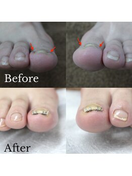 【巻き爪矯正】1回目