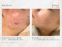 メレ(mele)/20代赤み／ニキビケア・毛穴