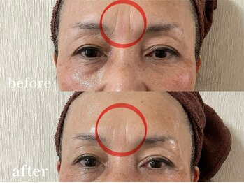 エピリス(Epiliss)/プラズマ眉間ビフォーアフター