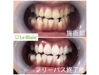 ルブラン 奈良店(Le Blanc)/しっつかり白くするなら