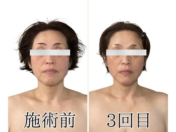 エリクシア 松戸/40代リンパ小顔矯正