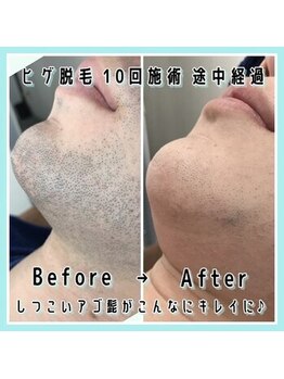 ミスターセブン 中野坂上店(Mr7)の写真/【ヒゲ脱毛+光フェイシャルセットがおすすめ◎】お好みに合わせて、ひげの濃さや形を整える事で好印象に♪