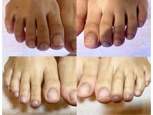 ビサンテ サロン/爪の悩みを解消できるケア足事例