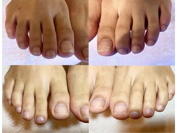 ビサンテ サロン/爪の悩みを解消できるケア足事例