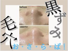 ア クイーユ(Accueil)/黒ずみおさらば！毛穴ケアコース