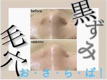 ア クイーユ(Accueil)/黒ずみおさらば!毛穴ケアコース