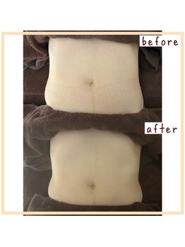 シンシンラボ 豪徳寺(SHINSHIN Lab)/くびれメイクや痩身にラジオ波♪