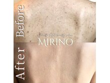 ミリノ(Mirino)/背中ハーブピーリング♪