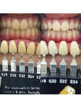 トウキョウスワーズ 池袋店(TOKYO SWRS)/#ホワイトニング #池袋 #渋谷