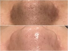 シルク ド リバー 銀座店(Silk de River)/ハイドロ+エクストラクション