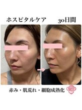 ケンビラク(Kenbiraku 健美楽)/赤み・肌荒れ・細胞成熟化　30日