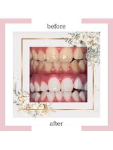 アイズ ビューティケア(eyes. beauty care)/セルフホワイトニング♪♪