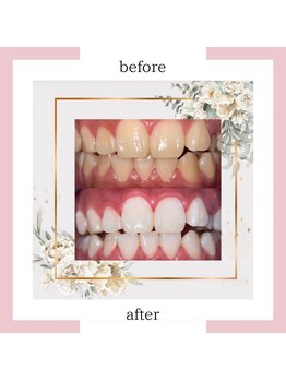 アイズ ビューティケア(eyes. beauty care)/セルフホワイトニング♪♪