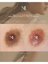 ユーエステティック(U AESTHETIC)/乳輪メラニンケア