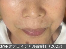 オアシスラグーン(OASIS LAGOON)/お任せフェイシャル（症例1）