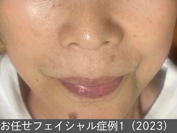 オアシスラグーン(OASIS LAGOON)/お任せフェイシャル(症例1)