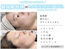 ラヴィス(ravis)の雰囲気（圧倒的実感！韓国肌管理！新技術！肌を育てるピーリング♪）
