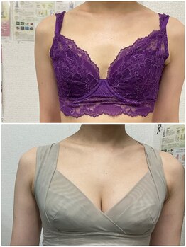 バーディー(BIRDIE)/施術５カ月/４０代/B→Dカップ