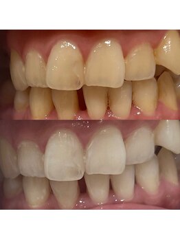 ハリス(HARIS)/セルフホワイトニング