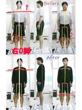 姫路なごみ整体院 なごみ鍼灸院/改善例（右ふくらはぎ右臀部痛）