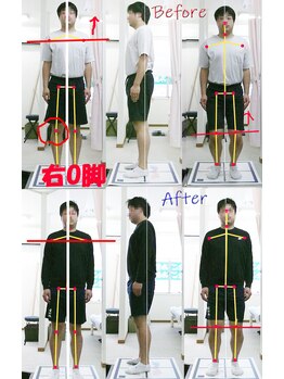 姫路なごみ整体院 なごみ鍼灸院/改善例（右ふくらはぎ右臀部痛）