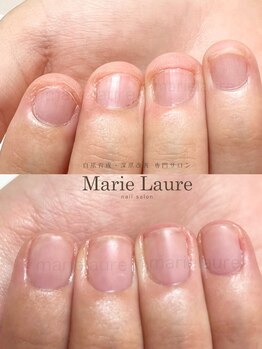 マリーロール 淀屋橋本店(Marie Laure)/自爪育成/深爪矯正/ネイルケア