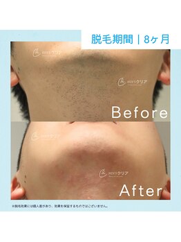 メンズクリア 高知帯屋町店/【メンズクリア】お客様の施術例