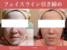 ラーナ(Lana)の雰囲気（【リフトアップEMS】表情筋からグッと引き上げ！たるみ改善に◎）
