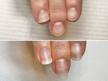 グラシュータン(gracieux temps)/深爪矯正