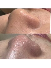 ラウレア(Laule'a)/毛穴ケア