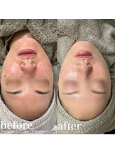 サロンエル(SALON el)/◇肌質改善ピーリング◇