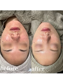 サロンエル(SALON el)/◇肌質改善ピーリング◇