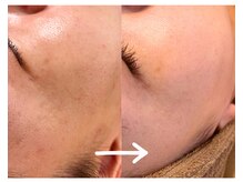 モネ(monet)/シミケア