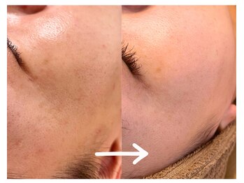 モネ(monet)/シミケア