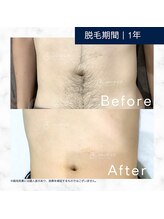 メンズクリア 松本店/【メンズクリア】お客様の施術例