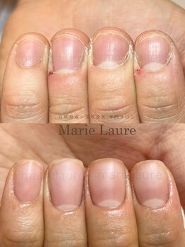 マリーロール 梅田店(Marie Laure)/自爪育成/深爪矯正/ネイルケア