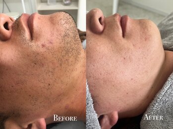 イースト(EAST)/ヒゲ脱毛10回以上