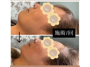 リラ鍼灸接骨院(Rela鍼灸接骨院)/レモンボトル