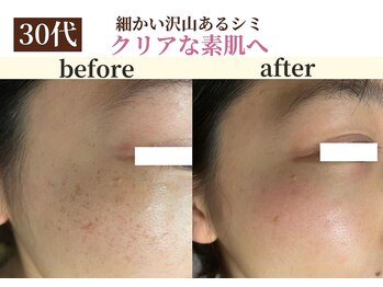 パールホワイトニング/ホワイトニングケアとシミケア