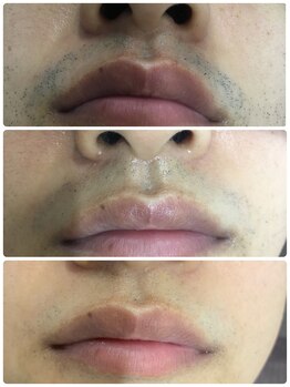 シア 静岡店(cia)/【ヒゲ脱毛】