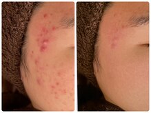 ハーブピーリング 恵比寿/ハーブピーリングbefore→after