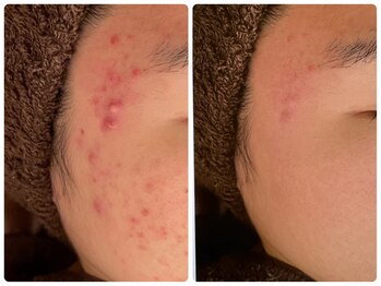 ハーブピーリング 恵比寿/ハーブピーリングbefore→after