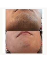 ムダ毛研究所 カンカ 銀座店(Kanka)/メンズヒゲbefore→after