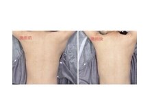 ラヴィオス 渋谷表参道店(RAVIOS)/ハーブピーリング 背中or二の腕