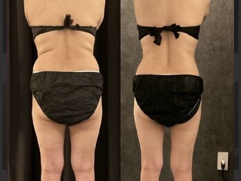 アリス 赤坂/脂肪冷却5回before→after