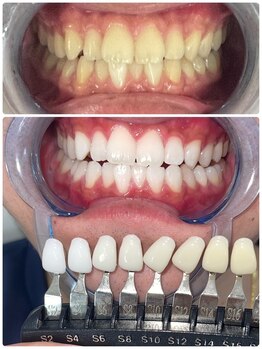 エクシアホワイトニング 札幌中島公園店/Before After［ホワイトニング］