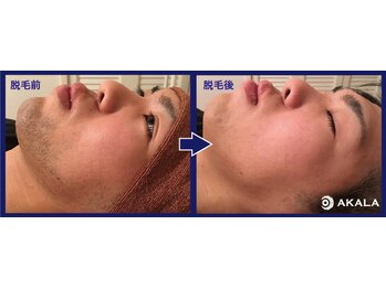 メンズ脱毛サロン アカラ(AKALA)/ひげ脱毛のビフォーアフター